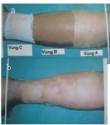 Điều trị vết bỏng nông trên cẳng tay. a) Vùng A phủ băng nano bạc chế tạo;Vùng B phủ băng Anson; Vùng C phủ bạc -sunfadiazin; b) sau 3 ngày điều trị