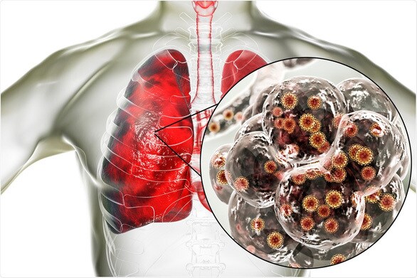 Các hạt li ti của virus SARS-CoV-2 xâm nhập vào phổi. Ảnh: SHUTTERSTOCK