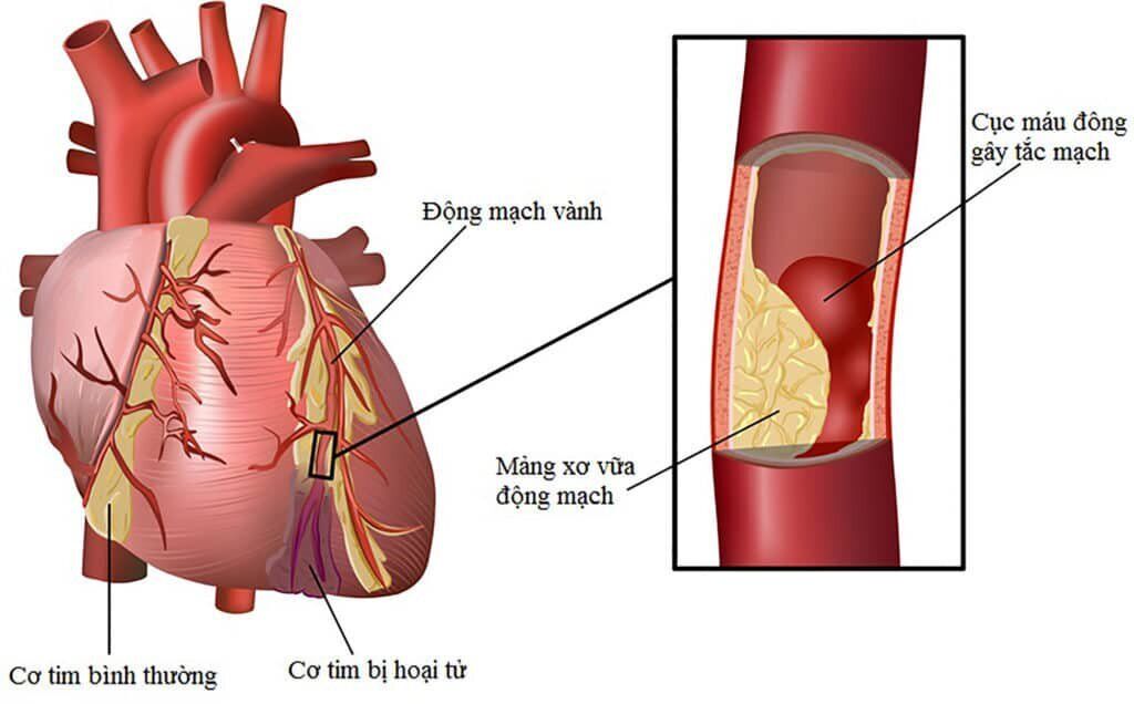 Cục máu đông gây tắc mạch có thể ảnh hưởng đến tim.