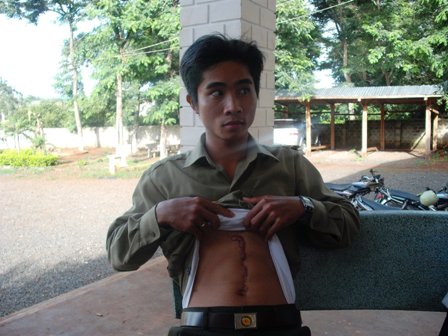 Anh Nguyễn Kim Mưu và vết đạn bắn đến nay vẫn chưa gắp được đầu đạn ra khỏi cơ thể.
