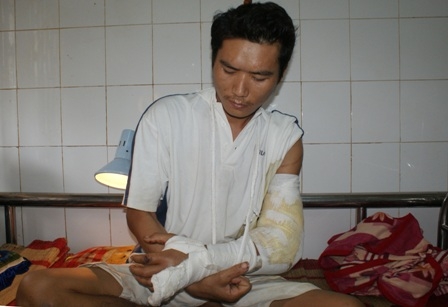 Bệnh nhân Lê Văn Kiên với cánh tay trái bị đứt lìa đã được phẫu thuật thành công.      