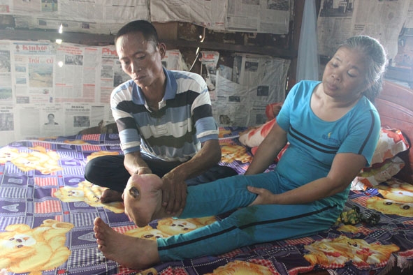 Chị Nguyễn Thị Hoa với chiếc chân phải đã cưa đi gần hết cả bàn chân.