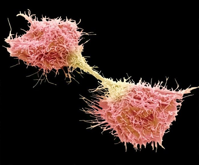 Tế bào ung thư. Ảnh minh họa
