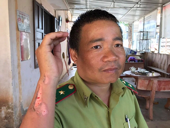 Vụ tưới xăng đốt khiến cánh tay phải của Kiểm lâm viên Huỳnh Ngọc Vinh bị bỏng