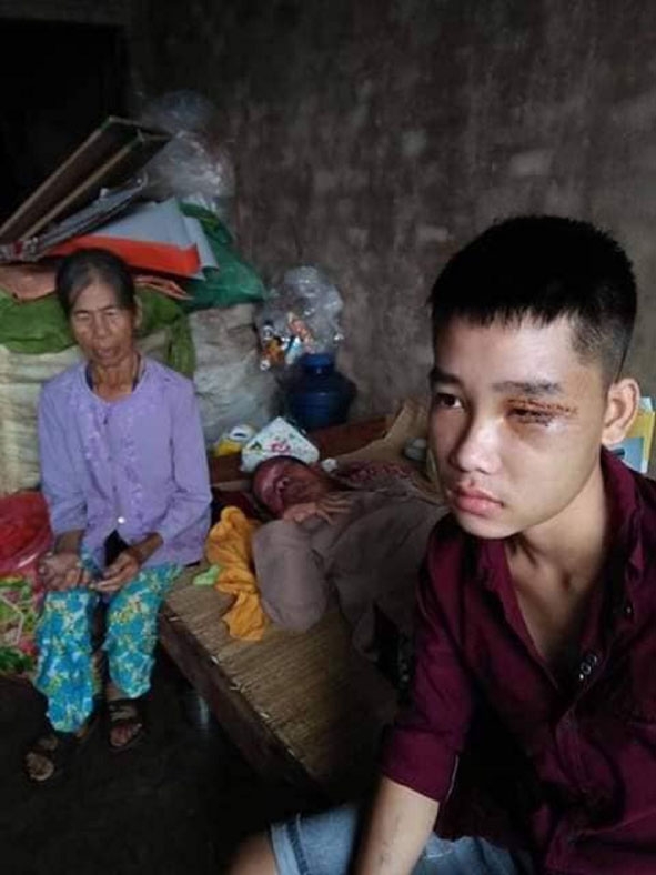 Sau tai nạn, em Tống Thanh Tú bị thương nặng mắt trái và có nguy cơ mù lòa nếu không được chữa trị kịp thời.